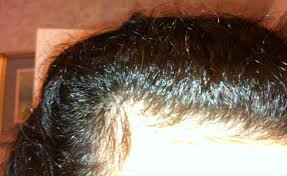 Reverse your thyroid hair loss. How My Diet Naturally Reversed My Hair Loss After Eight Years