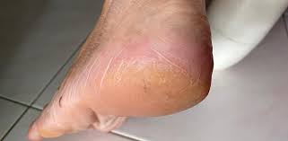 Kulit di kaki biasanya akan terkelupas ketika terlalu kering, sakit bahkan gatal. Cara Berkesan Lembutkan Tumit Kaki Yang Merekah