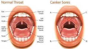 Image result for Canker sores symptoms roof of the mouth