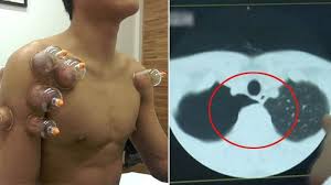 Naikan tubuh anda sampai dada sejajar. Obati Batuk Pakai Terapi Bekam Pria Ini Alami Nasib Mengerikan Lihat Paru Parunya Bangka Pos