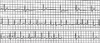 Sick Sinus Syndrome A Review American Family Physician