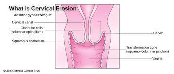 Askthegynaecologist Good Morning To You All Here At Atg Cervical Ectropion Cervical Erosion Atgcervicalectropion Atgcervicalerosion What Is Cervical Ectropion Cervical Ectropion Also Known As Cervical Erosion And Ectopy Is A Very