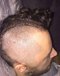 The club can confirm that ryan mason sustained a skull fracture in our fixture. Ryan Mason Reveals Horror Scar From Head Injury As He Nears Return Marca In English