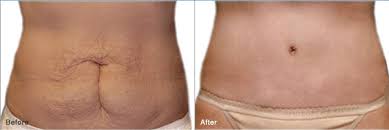 Pin On Liposuction Procedures Before After Photos