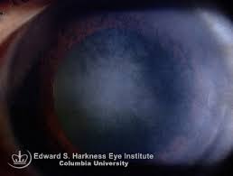 Herpes simplex virus, herpetic stromal keratitis, cornea. Interstitial Keratitis Columbia Ophthalmology