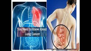 The malignant disease which affects a lung is known as lung cancer. Early Signs And Symptoms Of Lung Cancer Stages How To Identify You Have Lung Disease Youtube