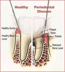 Periodontal Disease Four Corners Periodontics