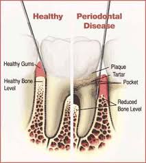 periodontal disease four corners periodontics