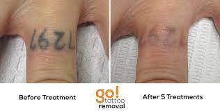This Knuckle Tattoo Is More Then Half Gone After 5 Laser Tattoo Removal Treatments A Few More And It Will On Cover Up Finger Tattoos Tattoo Removal Diy Tattoo
