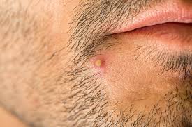 Cauzele infectiei urinare pot fi. Foliculita Si Abcesul Cutanat Cauze Si Tratamente