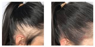 In men, the hair tends. Conditions That Cause Hair Fall And Hair Loss For Women Delaware Scalp Micropigmentation