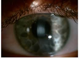 Main Complications Of Photorefractive Keratectomy And Their Management |  Opth