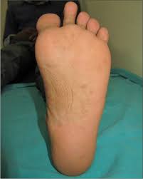 Image result for pompholyx soles of feet