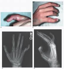 Image result for Lateral PIP Dislocation