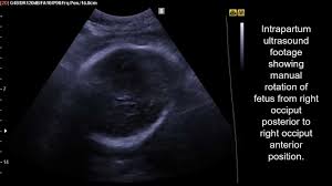 Image result for Manual Rotation in Occipitoposterior Presentation