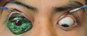 If you think that getting close to the eye with a laser is dangerous, you are right. Case Series Two Cases Of Eyeball Tattoos With Short Term Complications Sciencedirect