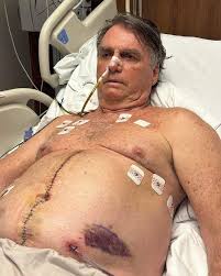 O ex-presidente Jair Bolsonaro (PL) publicou uma foto em todas as suas redes sociais mostrando sua atual situação no hospital e explicou como está sua recuperação; ele segue internado, não pode receber