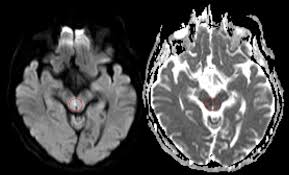 Hirninfarkt Ischamischer Schlaganfall Pathophysiologisches Fachwissen