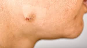 Image result for acne face