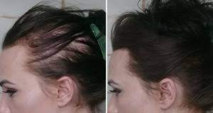 A solution of minoxidil is prescribed for male and male pattern baldness. Will Minoxidil Work For Me Will I Grow More Hair With Rogaine