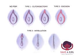 There are four types of fgm: Female Genital Mutilation Save A Girl Save A Generation