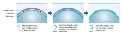 Ortho K Arlington Heights How Ortho K Works