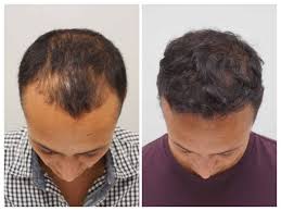 It is far more complicated than simply looking at photos and deciding which clinic looks like the best for you. Emmerdale S Chris Bisson Reveals He S Had A Hair Transplant To Retain His Good Looks And Protect His Career Manchester Evening News