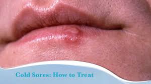 How To Treat Cold Sores Youtube