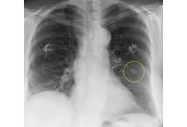 What is apico lordotic means. Chest X Rays 16 Subtle But Key Findings You Need To Know