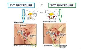Image result for Stress Incontinence