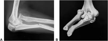 Image result for Coronoid Process Fracture