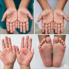 Image result for Hand foot and mouth disease HFMD roof of mouth