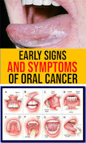 Image result for cancer tongue symptoms)