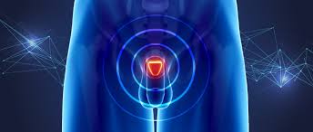 The causes of prostate cancer are largely unknown. Prostate Cancer Statistics World Cancer Research Fund International