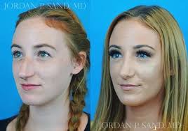Rhinoplasty 25