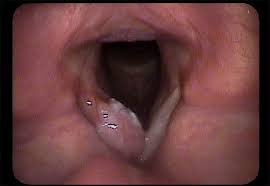 As you review these images and their descriptions, you. Cancer Sean Parker Institute For The Voice