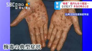 梅毒」何年もかけて進行する恐ろしい病気…感染急拡大のワケ、ピンク色「発疹」手のひらの「カサカサした斑点」性行為など性器・口の粘膜接触で感染、本当の怖さを知らない世代が増加  | SBC NEWS | 長野のニュース | SBC信越放送