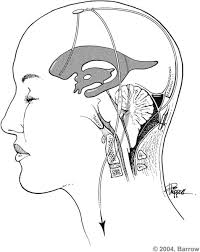 Slit Ventricle Syndrome Neupsy Key