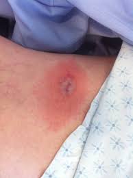 Image result for wolf spider bite skin