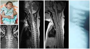 Image result for Spinal Trauma