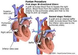 The Fontan The Third In The Series Of Hlhs Surgeries Pediatric Heart Heart Surgery Congenital Heart Defect Awareness