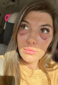 About 6 years ago, I had a poorly executed blepharoplasty to deal with the  bags that I always had under my eyes. The surgeon removed too much fat and  it left me