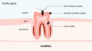He believes that you can prevent and heal cavities with nutrition. Root Cavity Causes Symptoms Diagnosis And Treatment