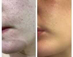 Here are five shampoos that will keep your hair healthy and gorgeous. Fungal Acne Defeated After 3 Days Of Using Nizoral Shampoo On My Face Acne