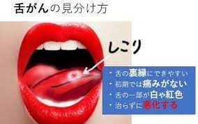 舌癌と口内炎の違い 膿栓 口臭 歯肉
