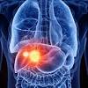 Liver cancer becomes very difficult to cure if a doctor diagnoses it at a later stage. 1