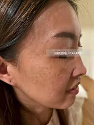 顾客做了定点式双眼皮+无痕抽脂后第五天效果,非常自然不影响日常生活询问/预约： wechat