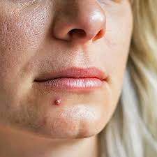 The sore will be formed in some parts of skin. Pimple Vs Cold Sore Learn The Differences Similarities