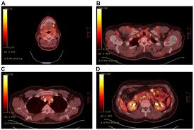Read about sarcoidosis, a chronic lung disease. Coexistence Of Sarcoidosis And Metastatic Lesions A Diagnostic And Therapeutic Dilemma Review