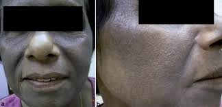 Image result for contact dermatitis